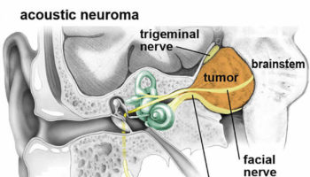 acoustic neuroma