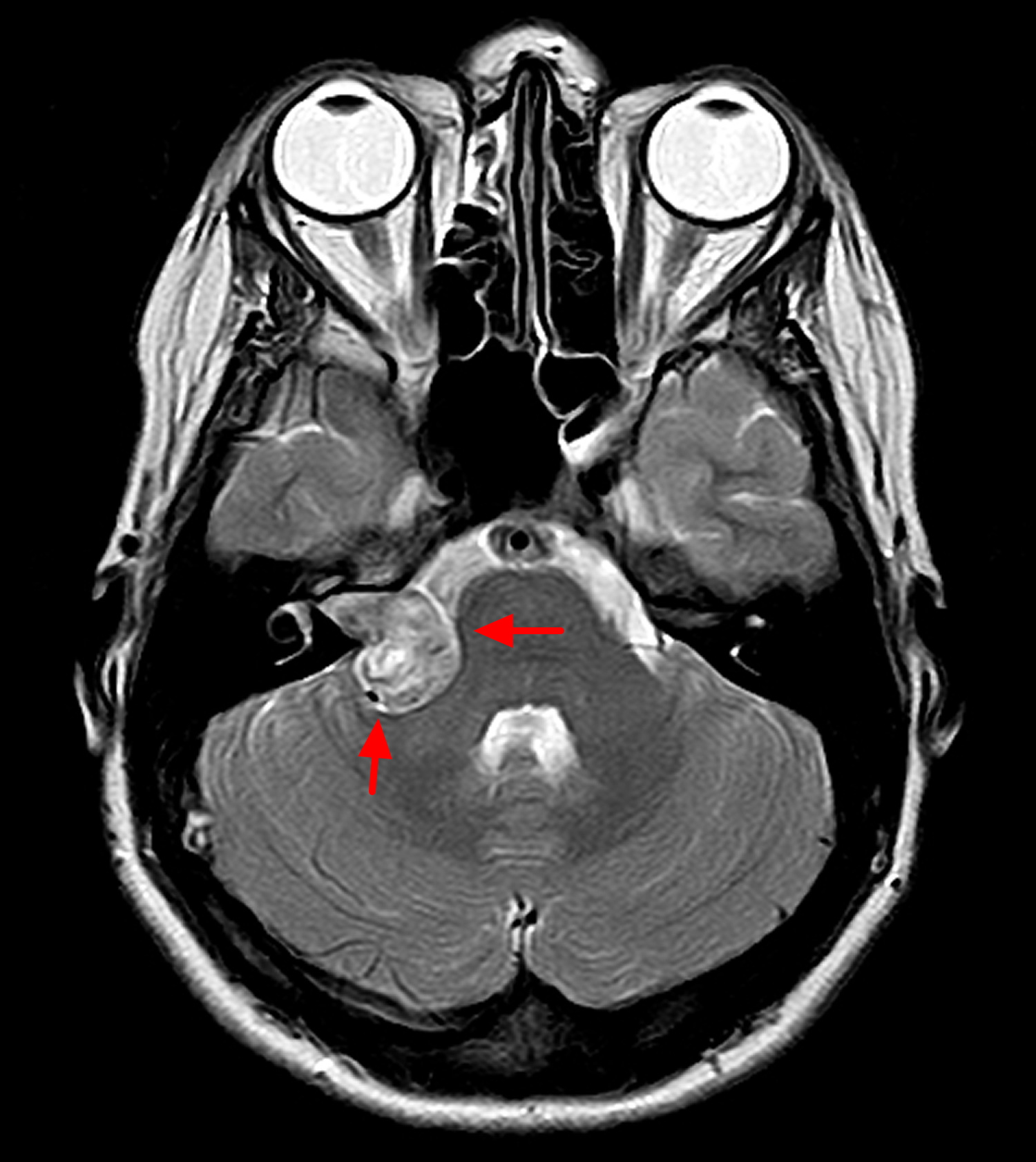 internal auditory canal mri with contrast
