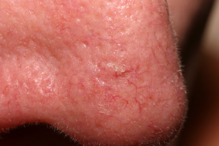 Actinic Keratosis - Causes, Symptoms & Actinic Keratosis Treatment