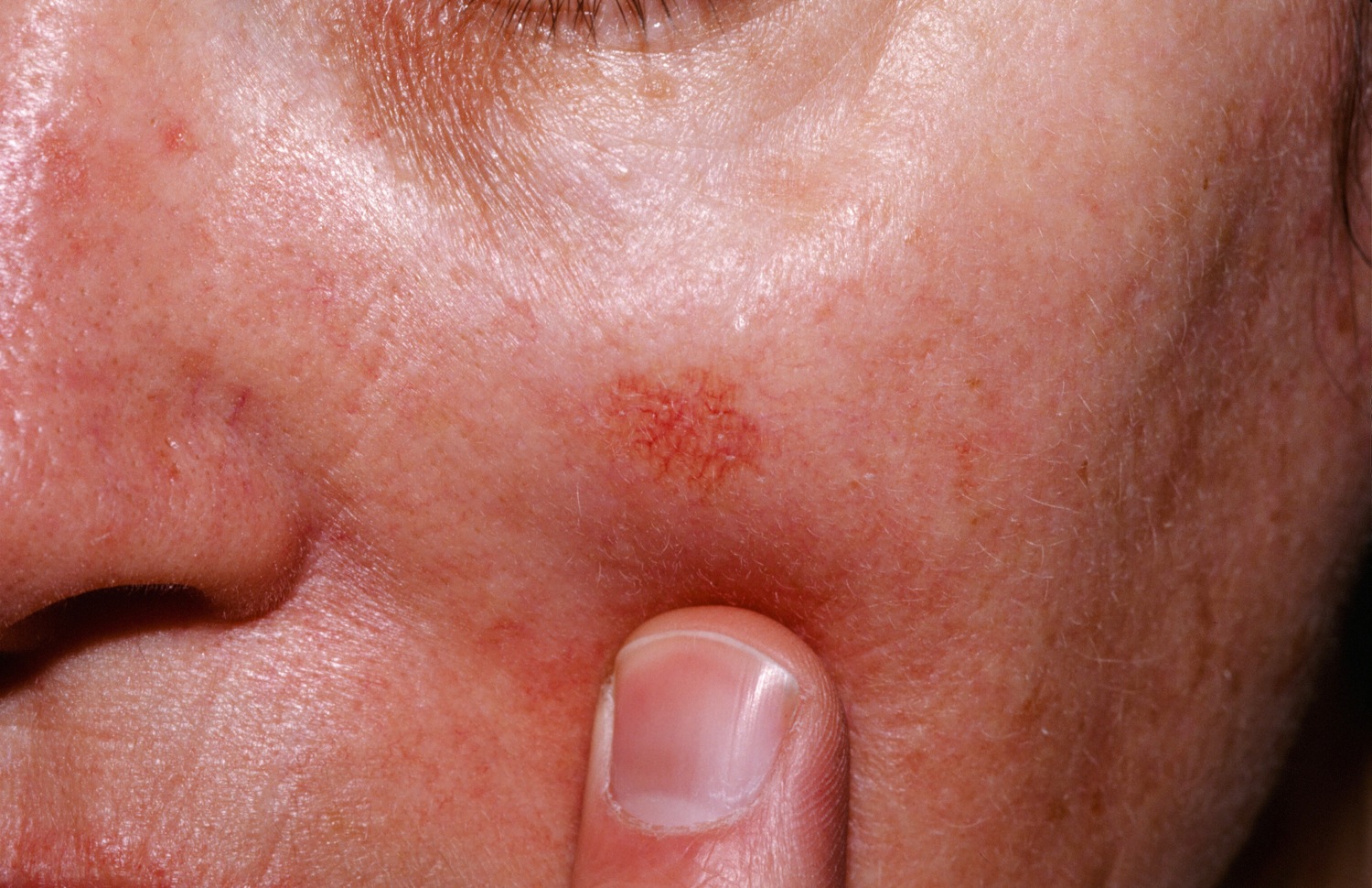 photos of actinic keratosis