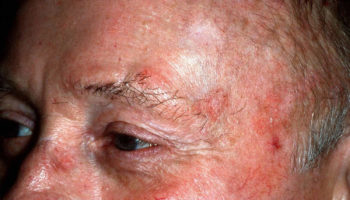 actinic keratosis