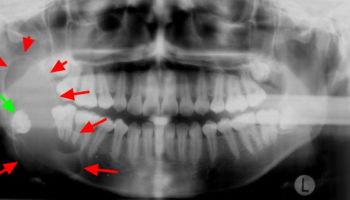 ameloblastoma