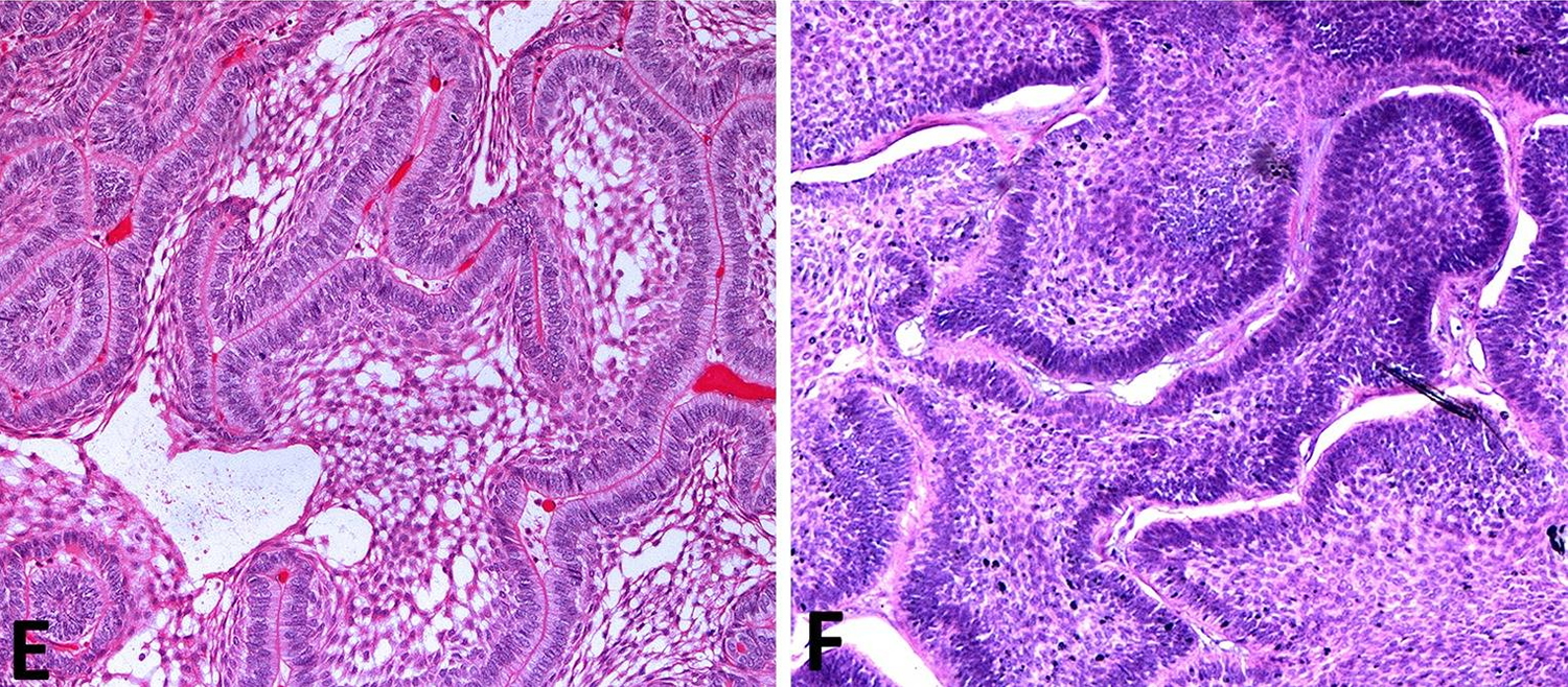 Ameloblastoma histology