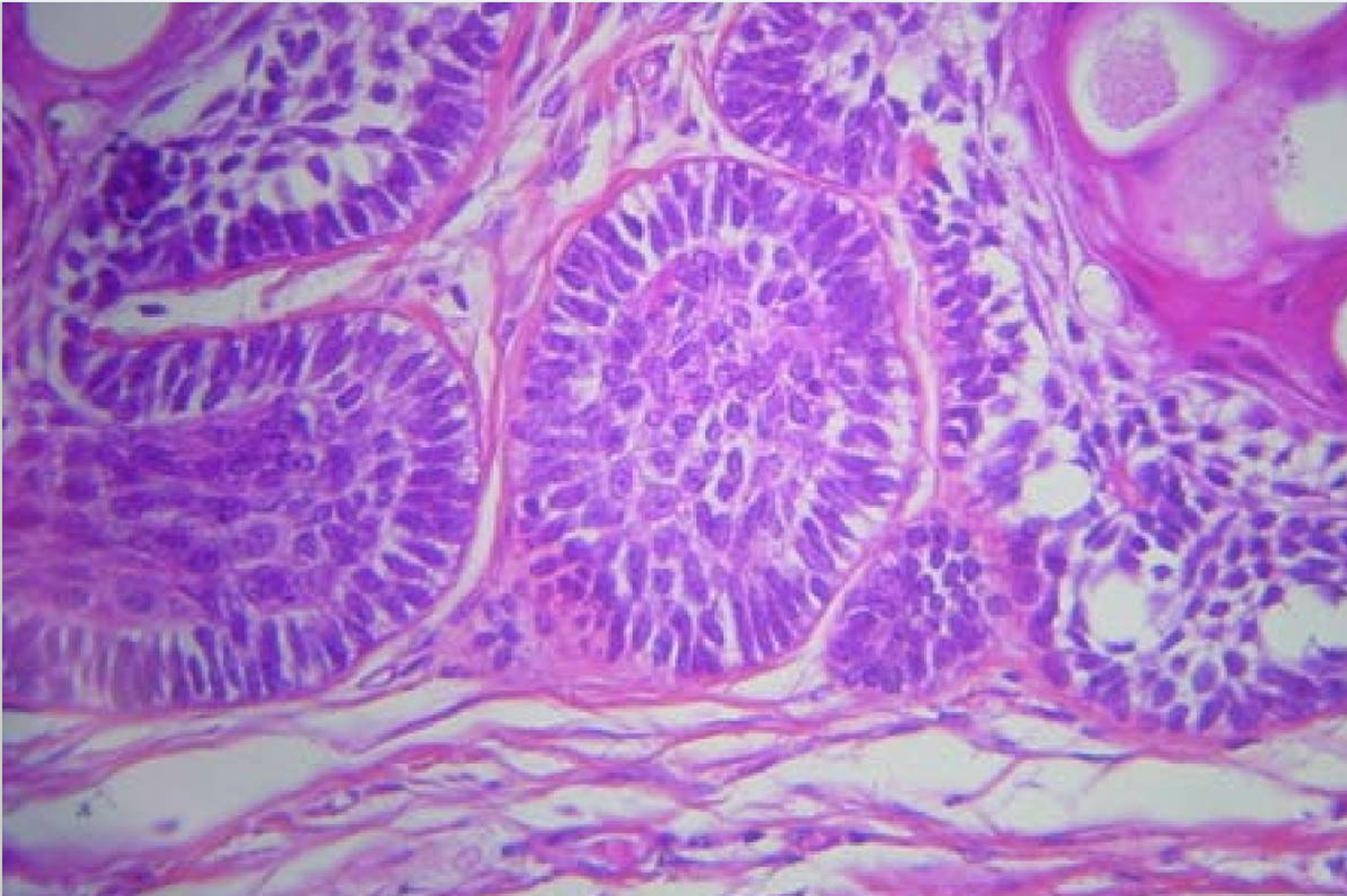 ameloblastoma histology