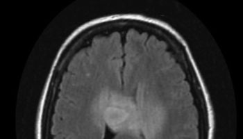 astrocytoma
