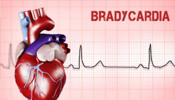 bradycardia