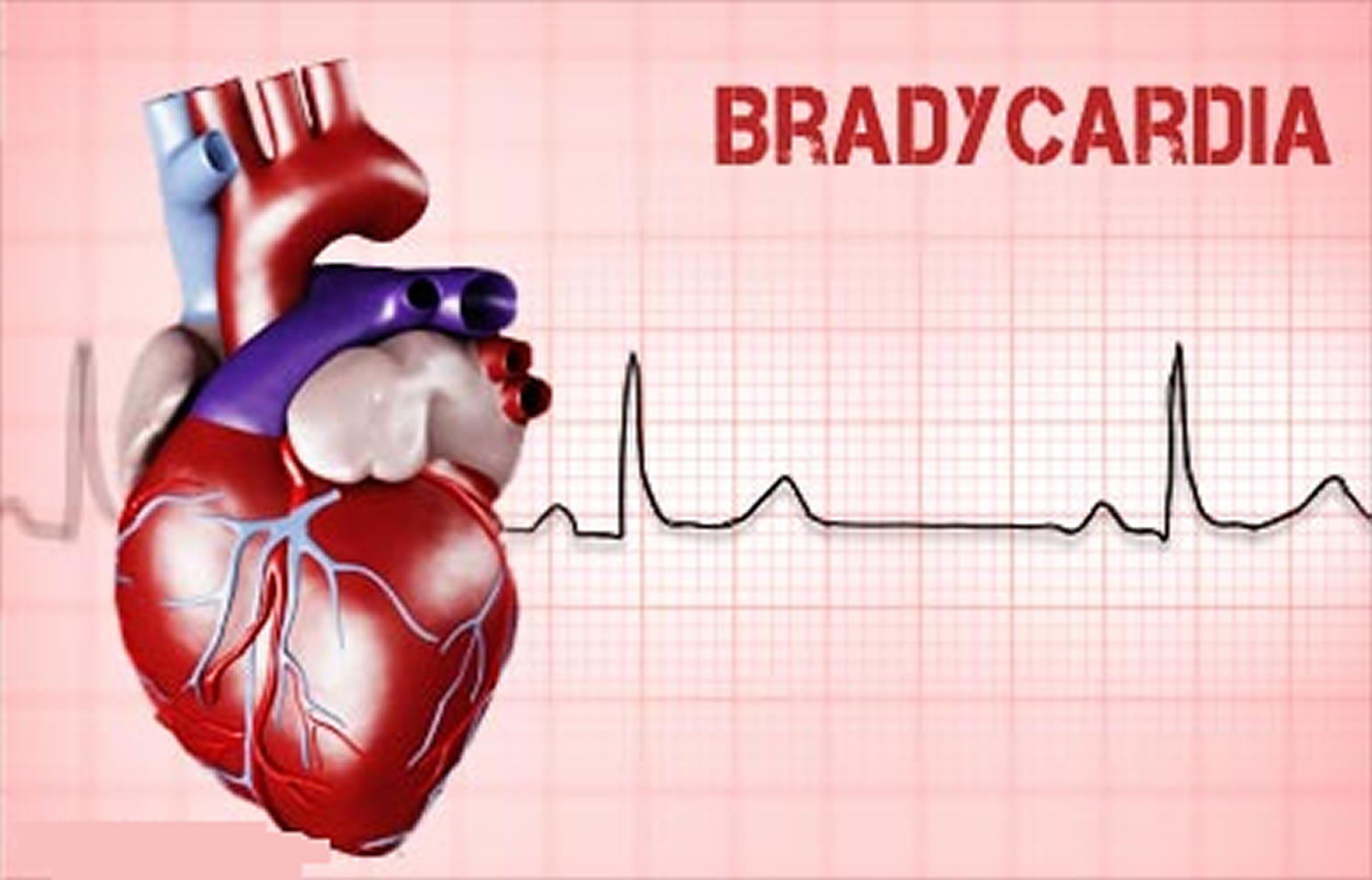 Bradycardia Sinus Bradycardia Causes Symptoms Diagnosis Treatment