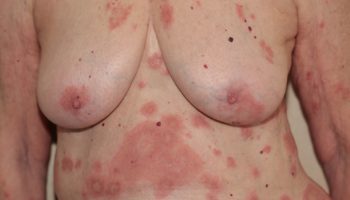 bullous pemphigoid – diffuse