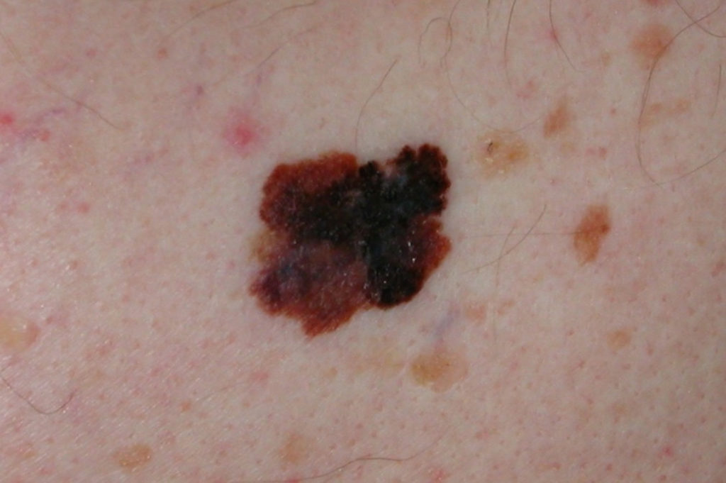 Moles Causes Types Abnormal Cancerous Moles