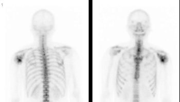 chondrosarcoma