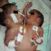 conjoined twins