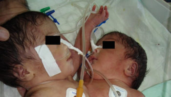 conjoined twins