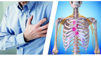 costochondritis 1