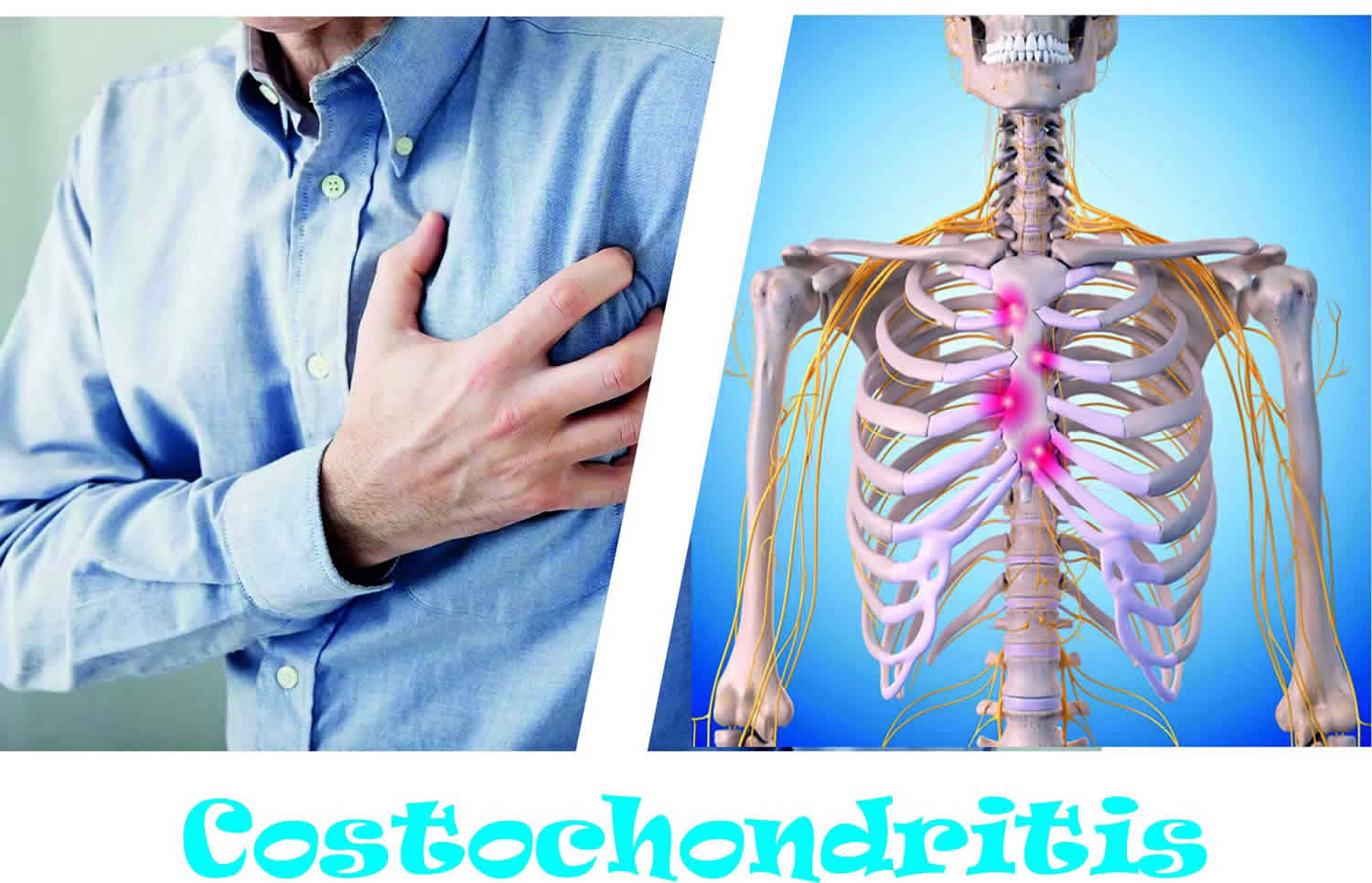 Symptoms costochondritis What is