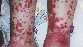 cryoglobulinemia rash