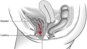 cystocele