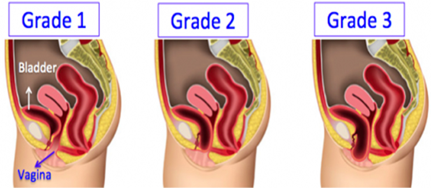 cystocele grading