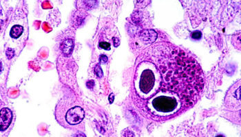 cytomegalovirus