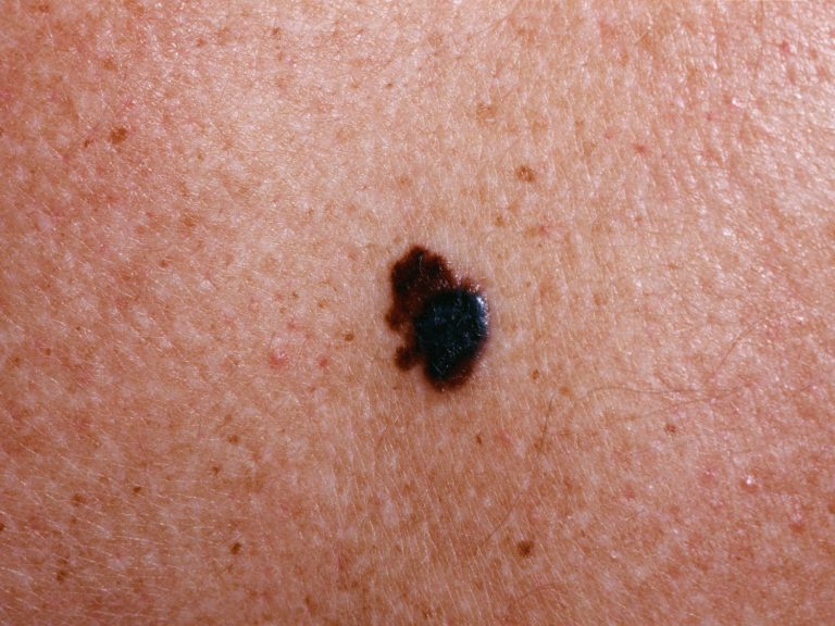 Skin Cancer Types Symptoms Melanoma And Treatment 