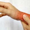 de quervain’s tenosynovitis 1