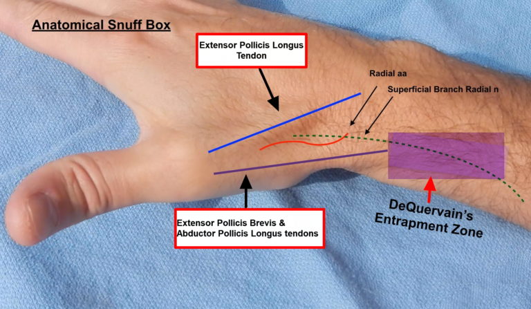 De Quervain’s Tenosynovitis - Causes, Symptoms, Test, Exercise, Surgery