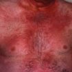 dermatomyositis rash