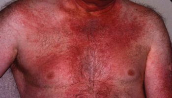 dermatomyositis rash
