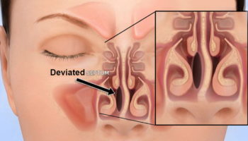 deviated septum