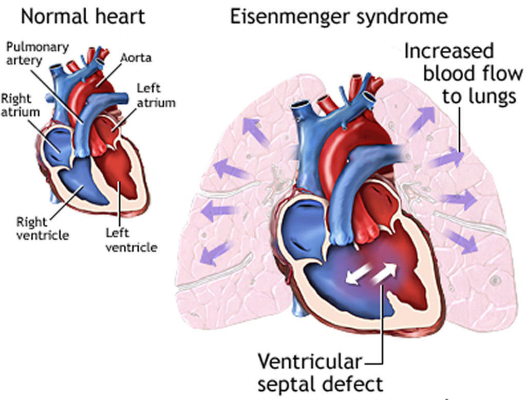 Eisenmenger Syndrome- Causes, Diagnosis, Life Expectancy & Treatment