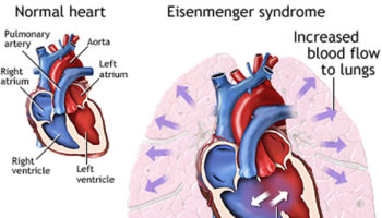 eisenmenger syndrome