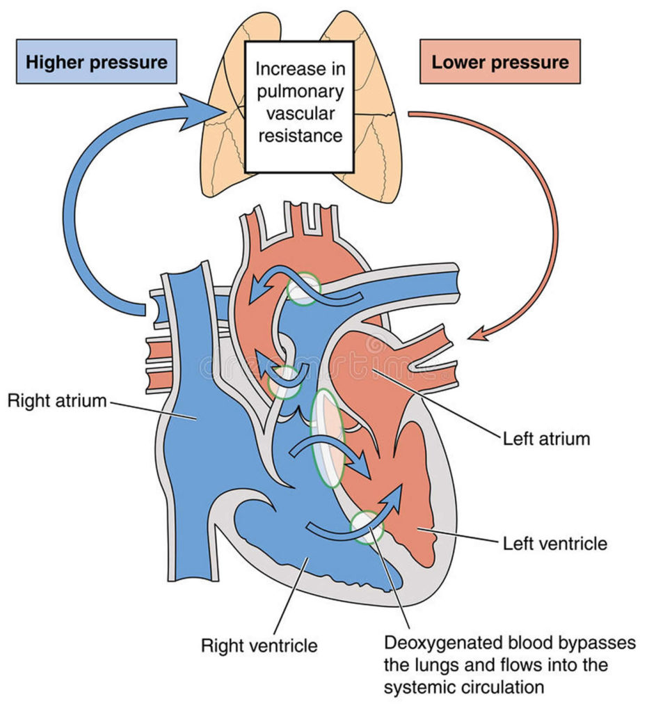 Eisenmenger Syndrome- Causes, Diagnosis, Life Expectancy & Treatment