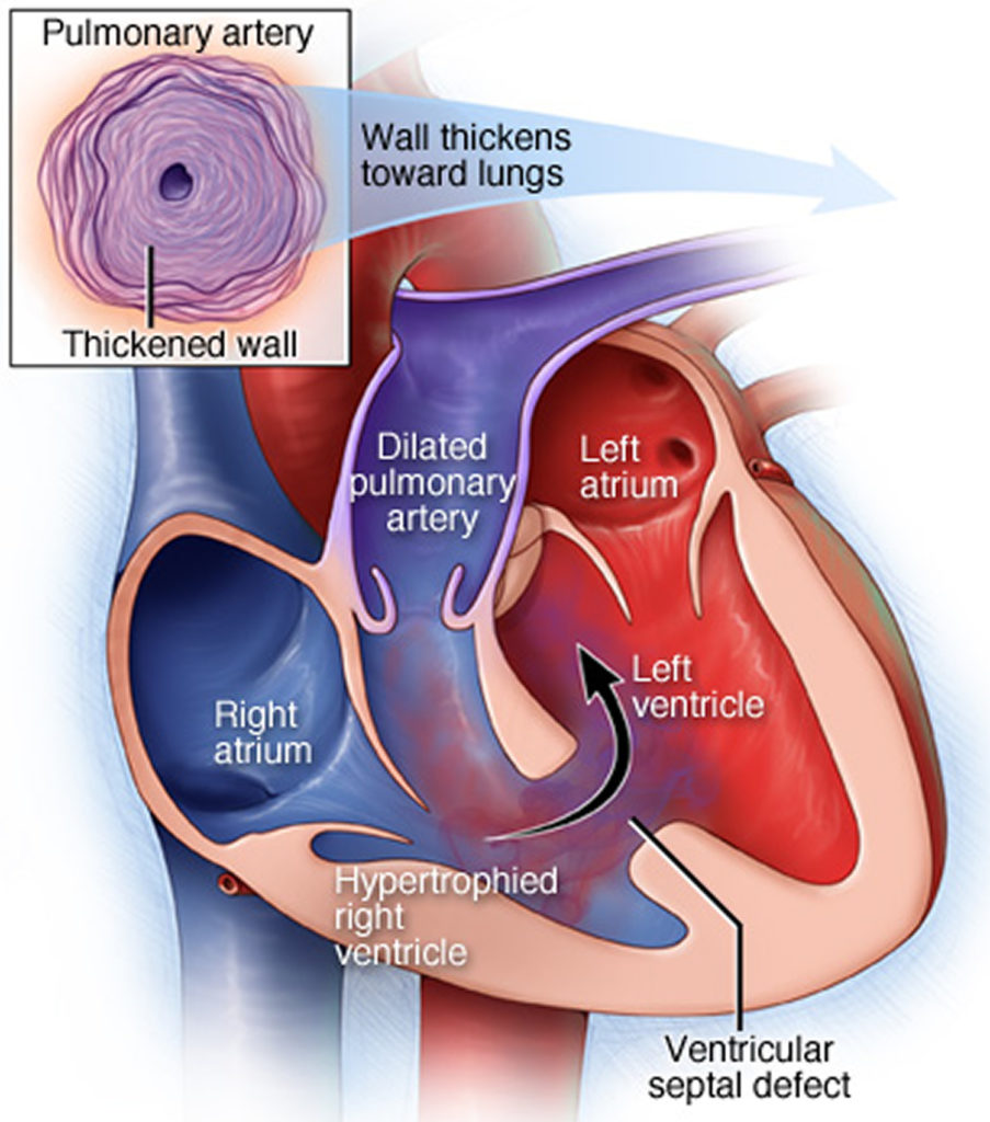 Eisenmenger Syndrome- Causes, Diagnosis, Life Expectancy & Treatment