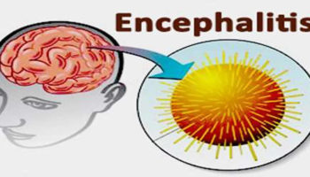 encephalitis