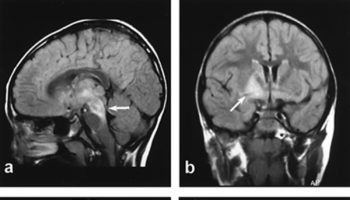 encephalitis lethargica