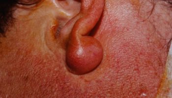 epidermoid cyst