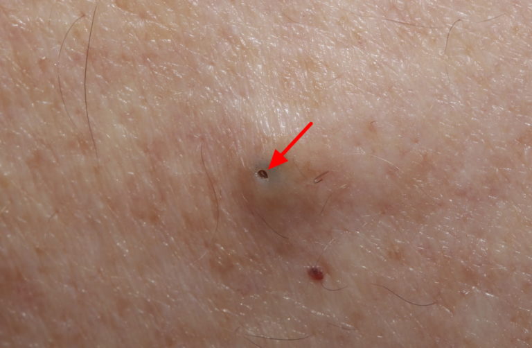 Epidermoid Cyst Infected Causes Symptoms Treatment