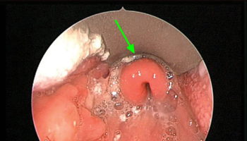 epiglottitis