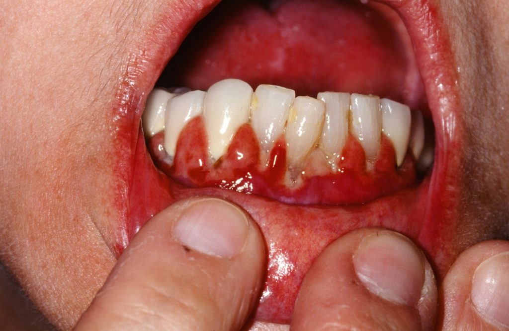 oral-lichen-planus-causes-symptoms-prognosis-diagnosis-treatment