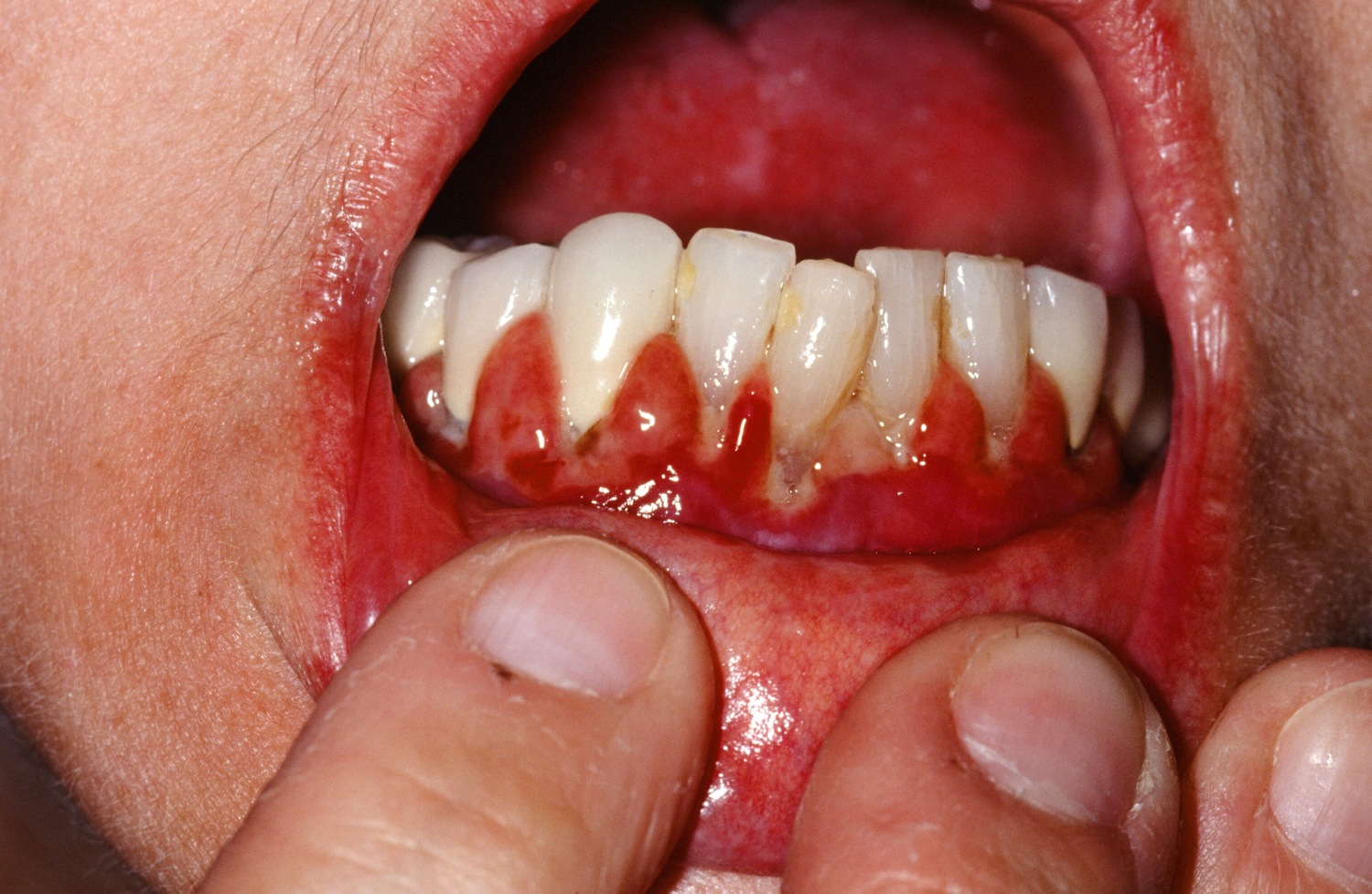 Erosive oral lichen planus