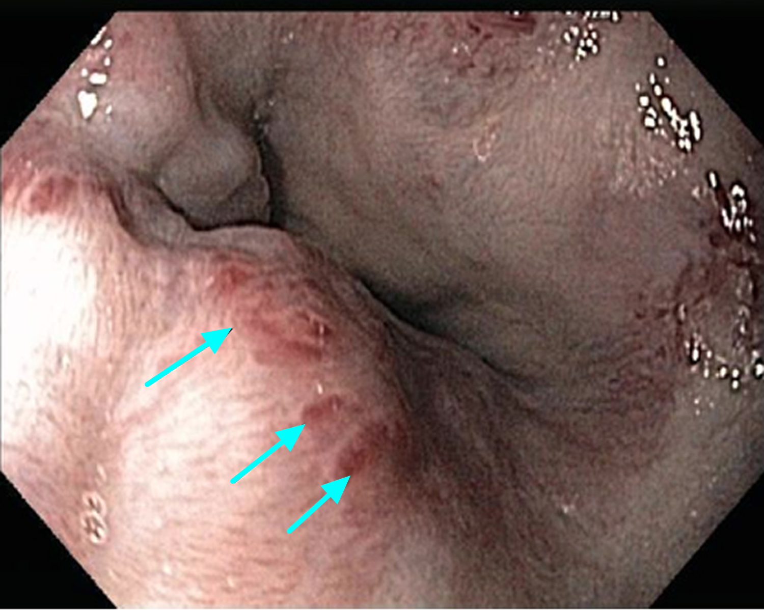 esophageal varices with red marks or red spots