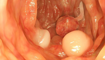 familial adenomatous polyposis