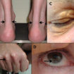 familial hypercholesterolemia