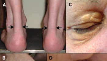 familial hypercholesterolemia