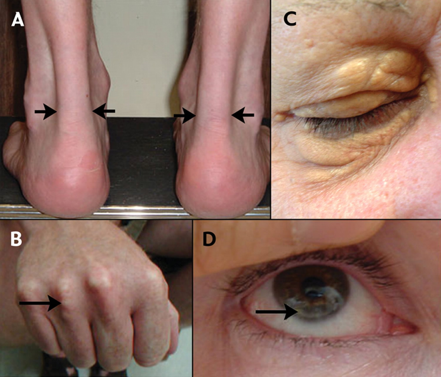 Familial Hypercholesterolemia Causes Genetics Symptoms And Treatment 9836