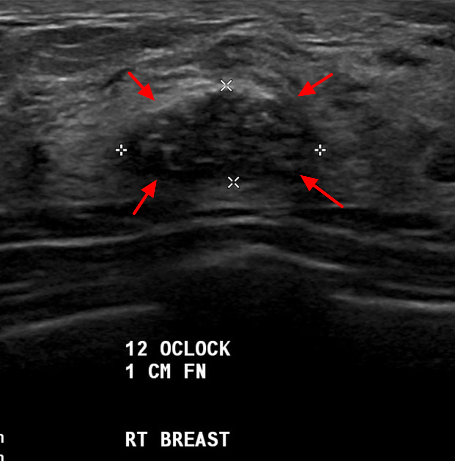 fibroadenoma