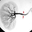 fibromuscular dysplasia
