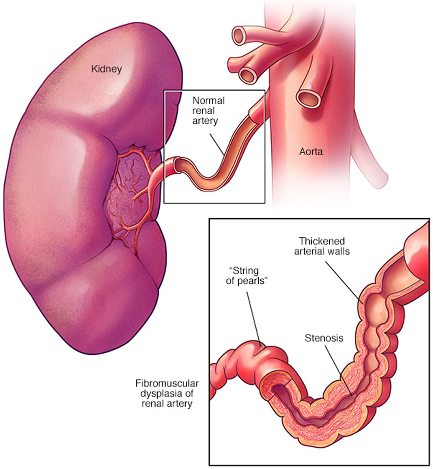 Нарушение стенки. Фибромускулярная дисплазия почечной артерии. Фиброваскулярная дисплазия почечных артерий. Фибромышечная дисплазия почечных артерий.
