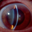 fuchs dystrophy
