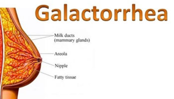 galactorrhea