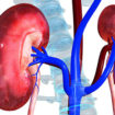 hemolytic uremic syndrome